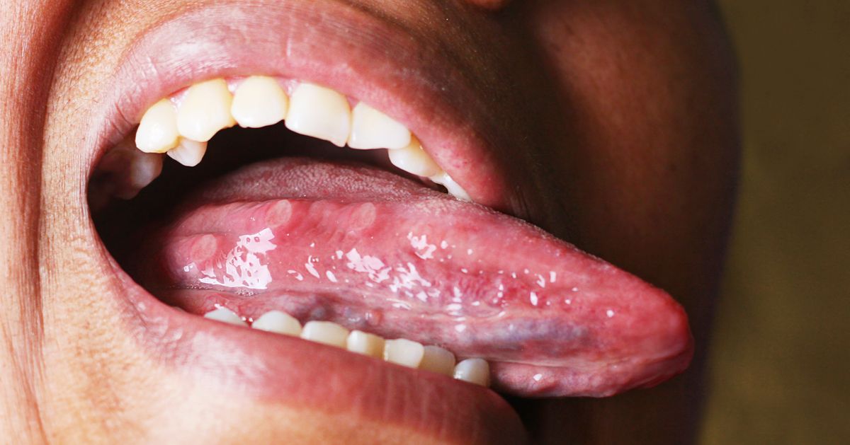 What Your Tongue And Tonsils Could Tell You About Your Sleeping Habits