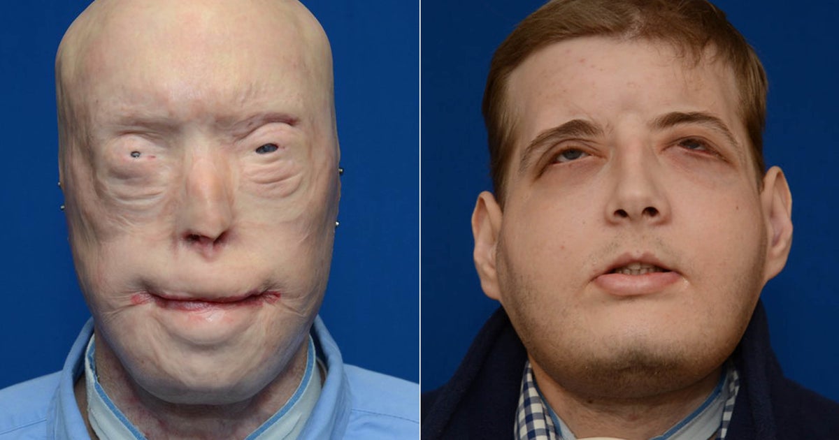 Graphic New Photos Of Face Transplant Show Burn Patient's Remarkable Rebirth