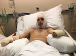 Man Who Mistook Sepsis Symptoms For Flu Has Both Legs Amputated