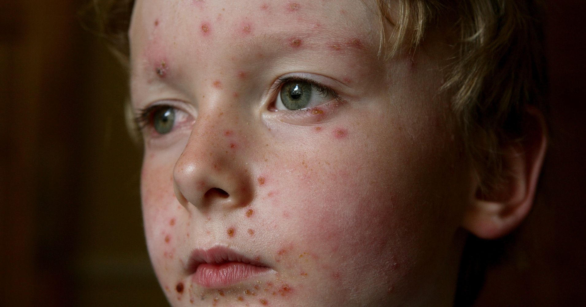 80-children-get-chicken-pox-at-school-with-low-vaccination-rate-huffpost