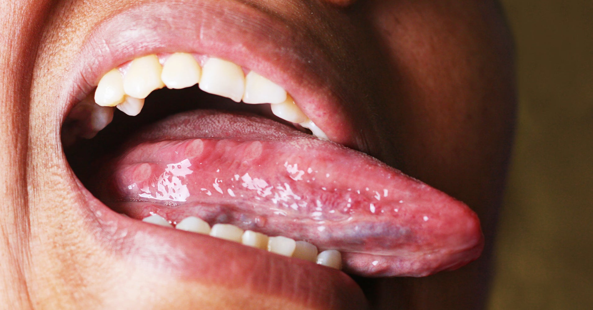What Your Tongue And Tonsils Could Tell You About Your Sleeping Habits HuffPost