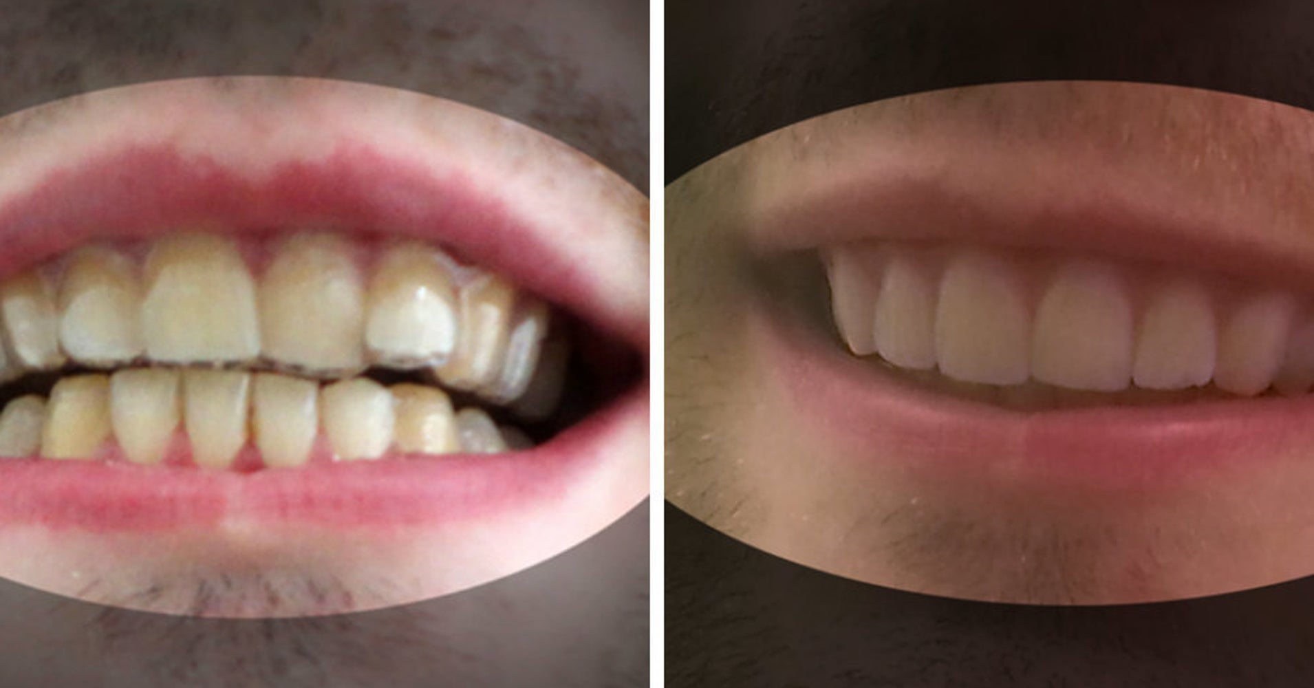 College Student Made His Own Braces For 60, And His Teeth Look