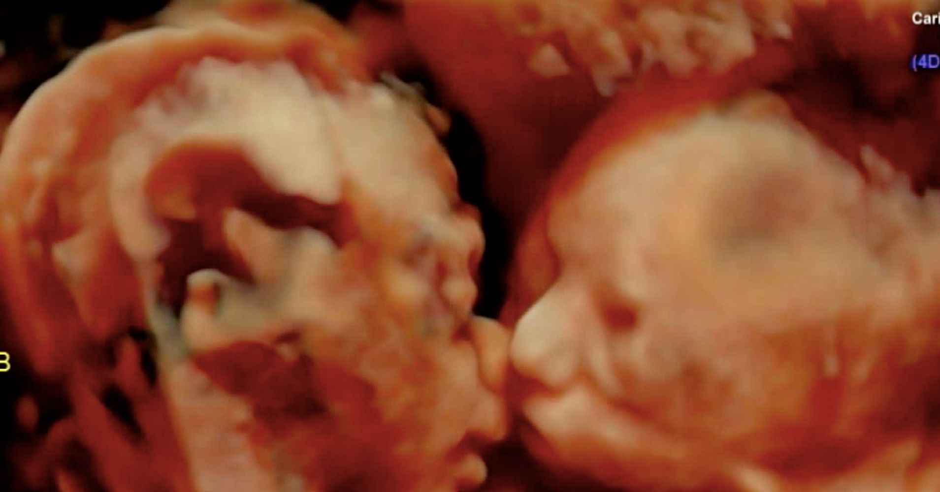 Amazing Ultrasound Shows Twins Sharing A Kiss In The Womb Huffpost 9060