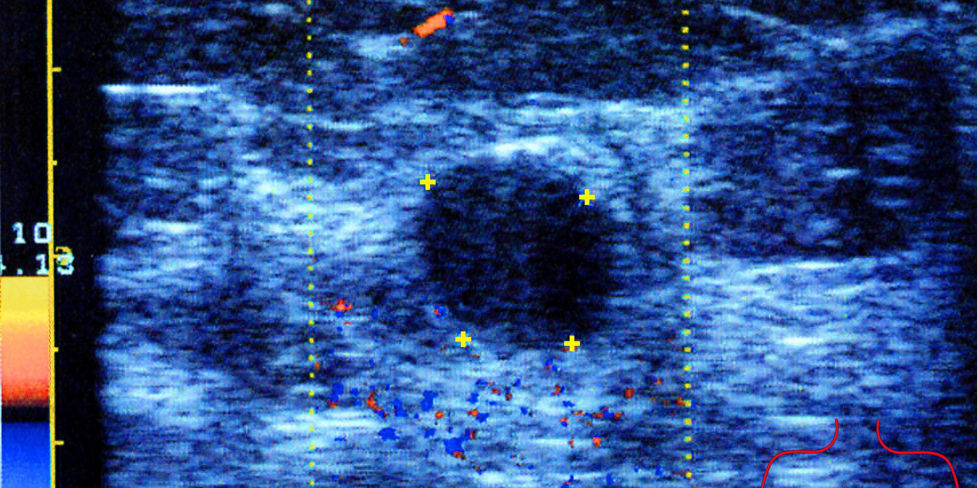 Spots On Breast Ultrasound