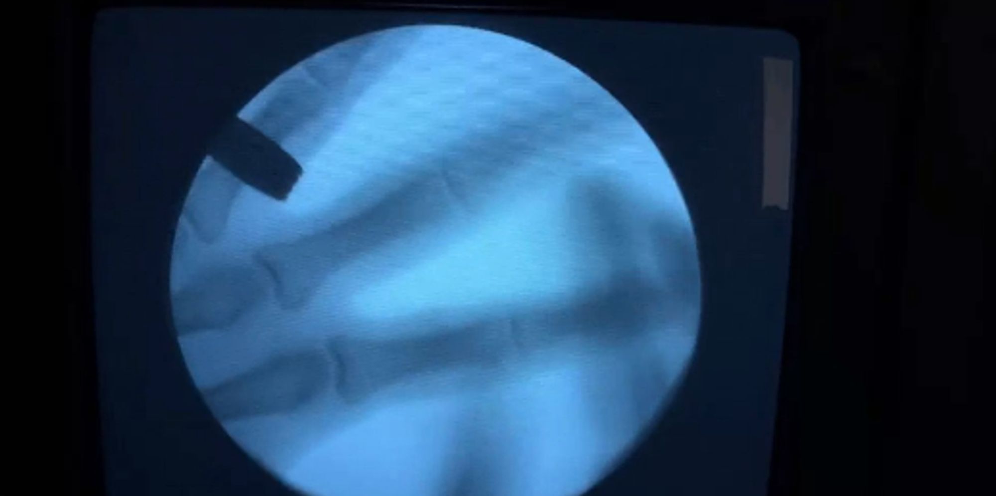 XRay Shows What Really Happens When You Crack Your Knuckles HuffPost UK