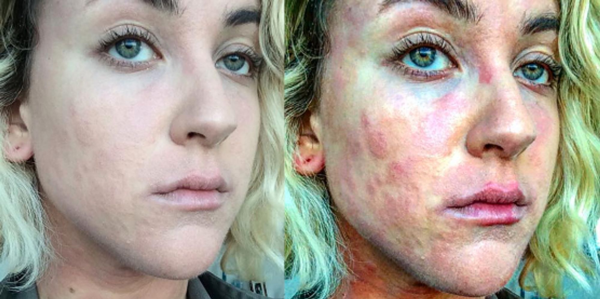 Woman With Psoriasis Shows What It S Really Like Living With The Skin