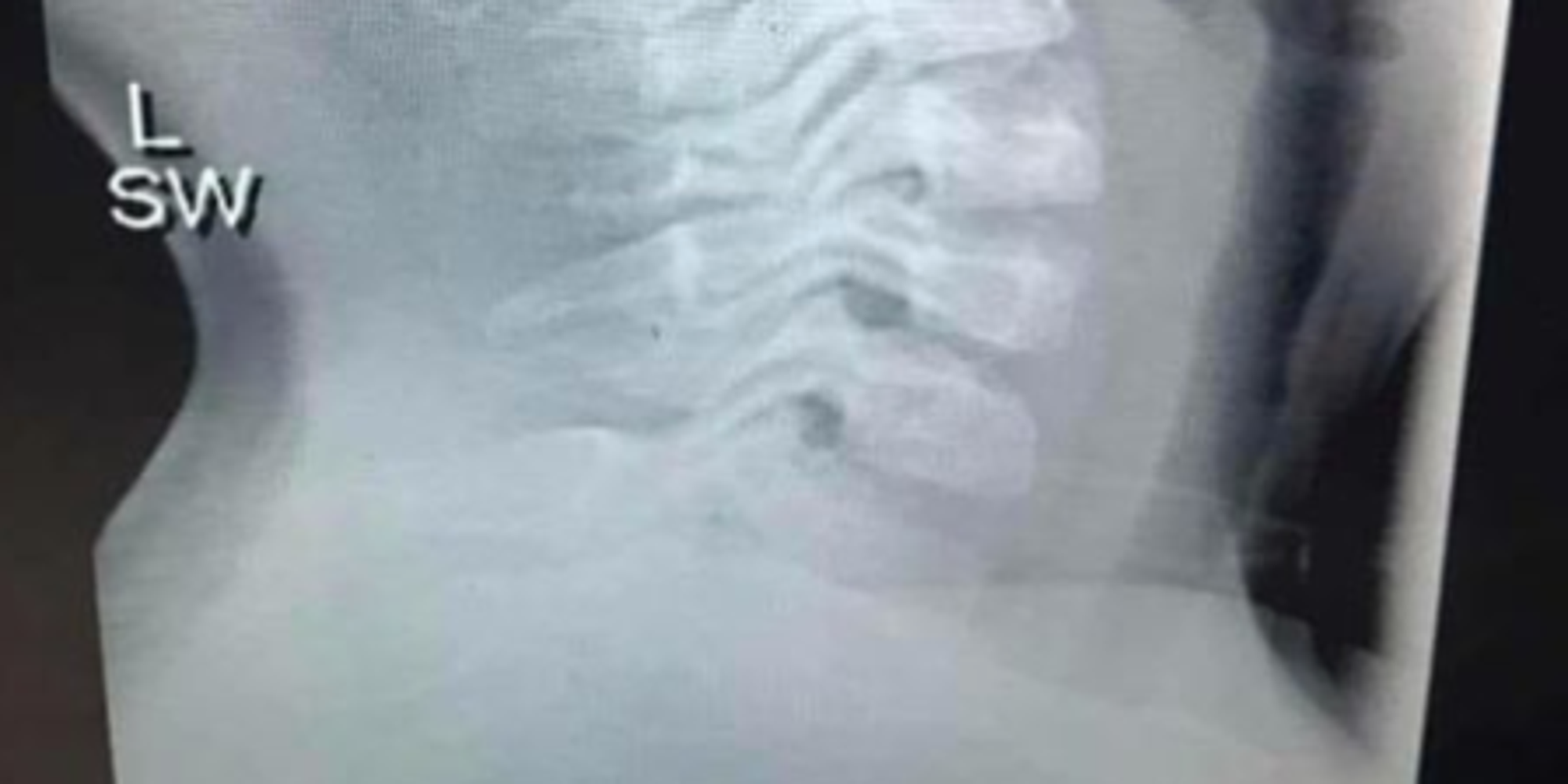 Mum Shares Shocking XRay Image Of Grape Stuck In Child's Throat As