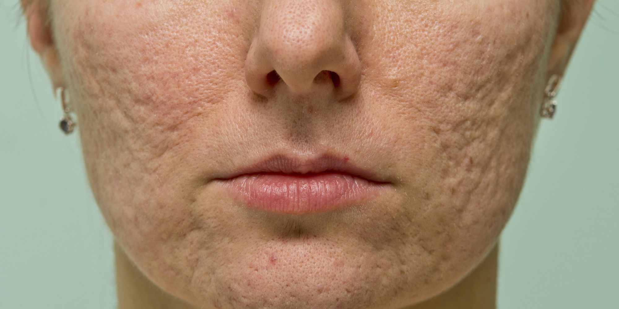 Acne Causes And Treatment Explained Huffpost Uk