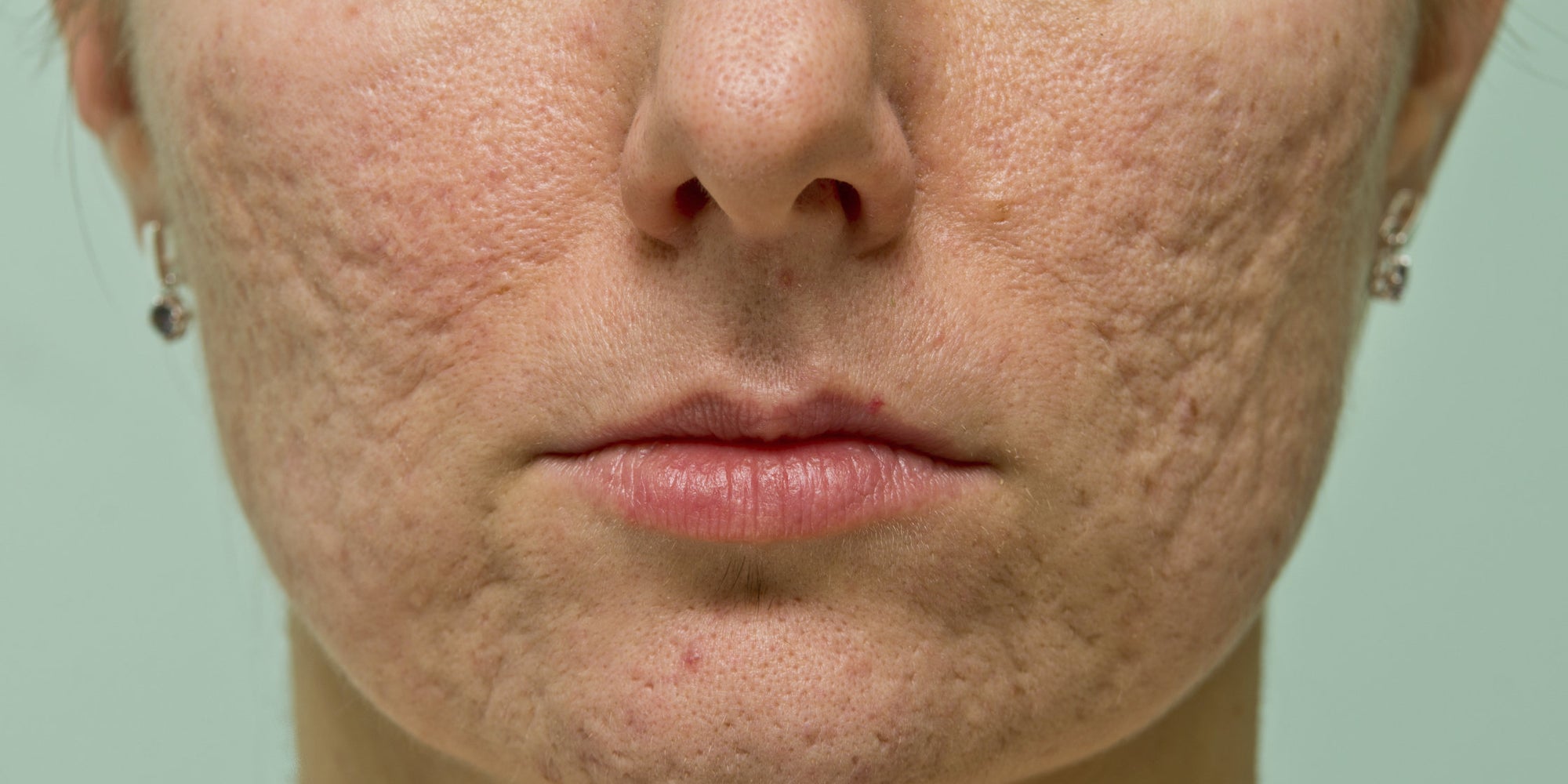 Acne Causes And Treatment Explained Huffpost Uk