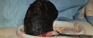 GIANT HAIRBALL WEIRD PHOTOS MEDICAL MARVELS
