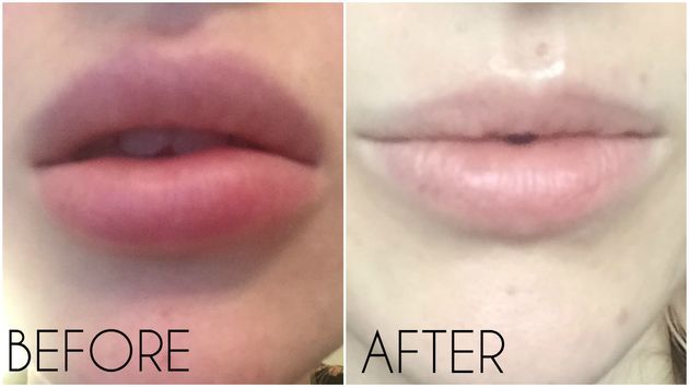 lip filler removal hyaluronidase picking safe works guide practitioner