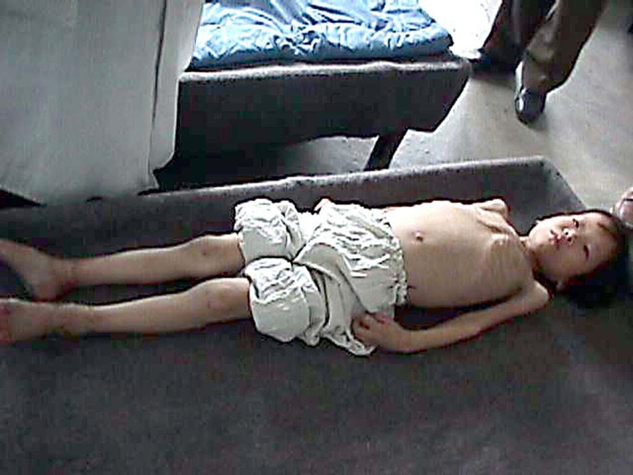 <strong>A North Korean boy lies in a hospital bed suffering from malnutrition&nbsp;</strong>