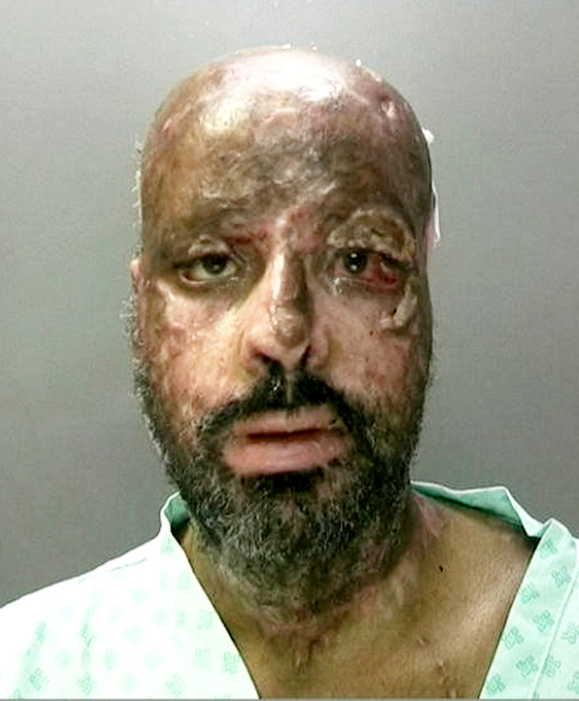 <strong>Mohammed suffered burns to his head after setting the passenger side of his cab alight on the night of the killings&nbsp;</strong>