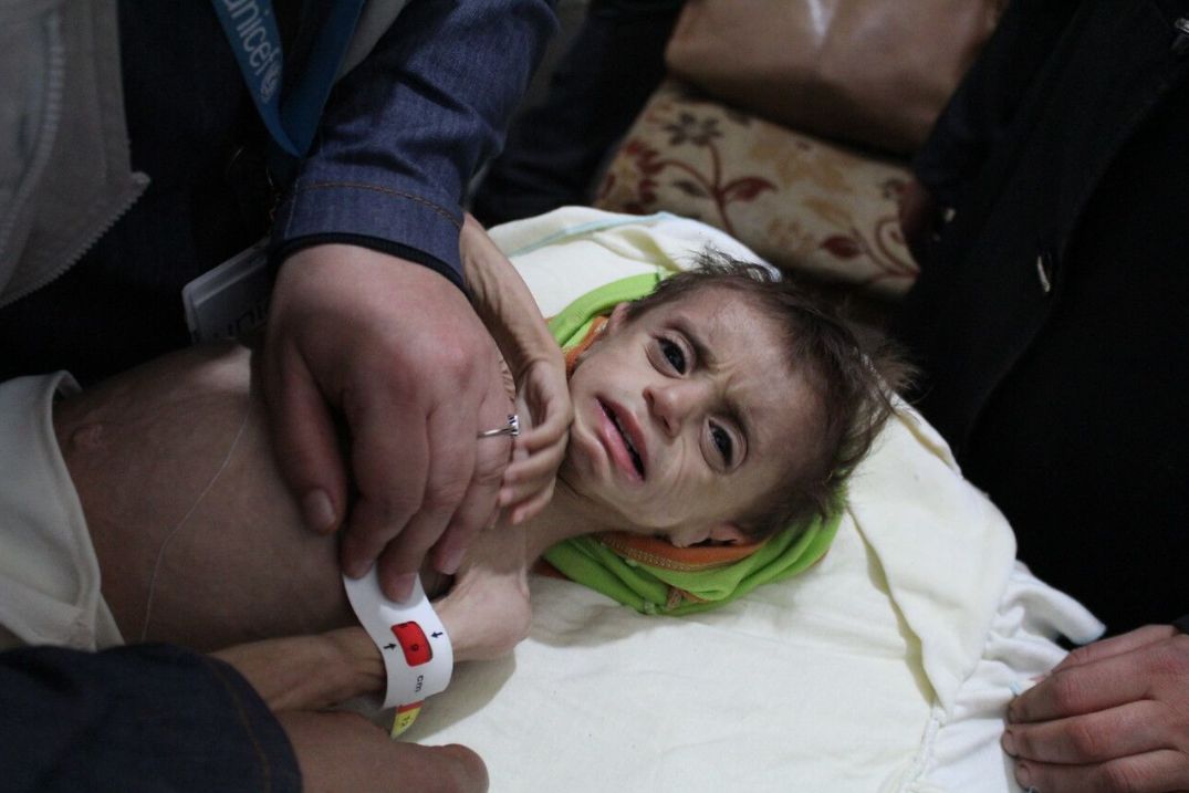 A severely malnourished child pictured in October at the Al Kahef hospital in Kafr Batna,&nbsp;east&nbsp;Ghouta, Syria