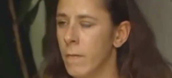 Woman's Eye Sealed Shut After Friend Mistakes Glue For Eye Drops
