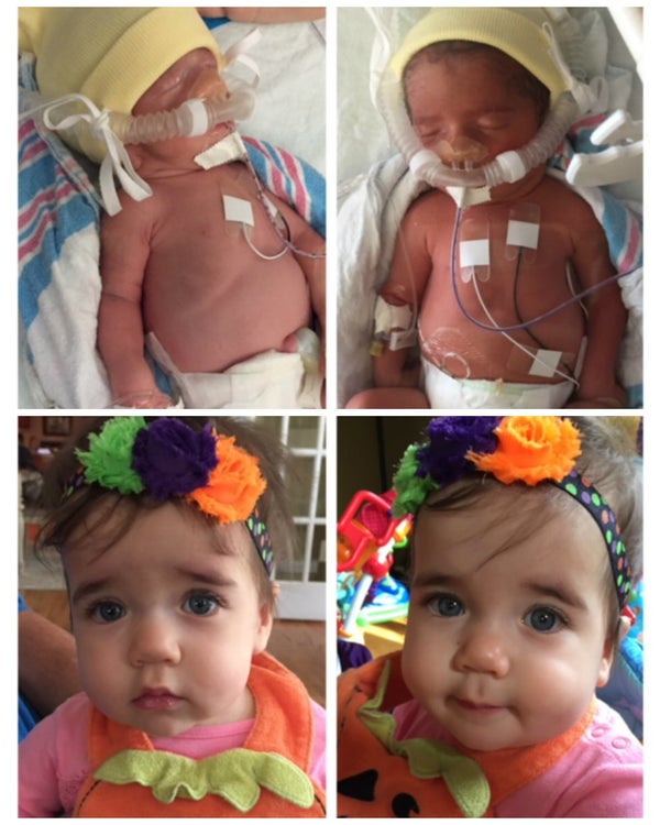 Photos Of Premature Babies Then And Now Show Their Incredible Journey