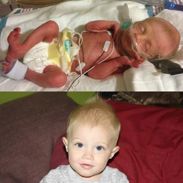 Photos Of Premature Babies Then And Now Show Their Incredible Journey