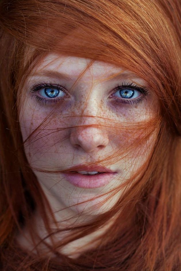 Leukoderma Pictures Of Face Redhead 103