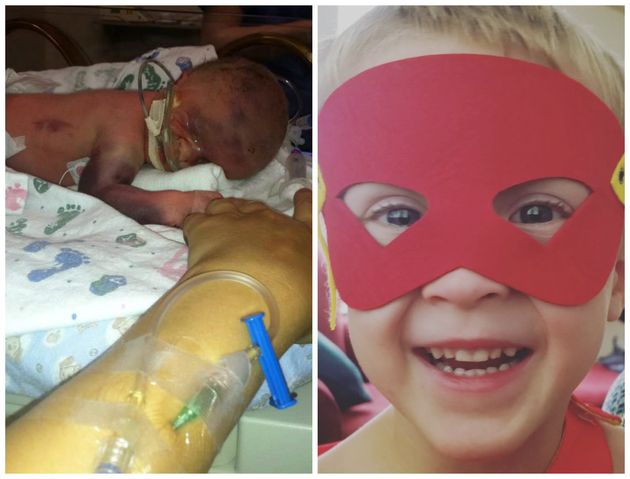 Emmett was born at 32 weeks gestation, weighing just 4 pounds. The 4-year-old now loves superhero capes and masks.