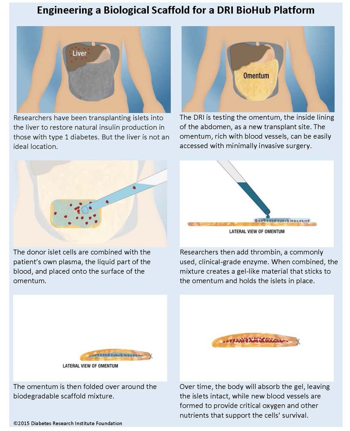 Innovative Type 1 Diabetes Transplant Frees Patient From Insulin