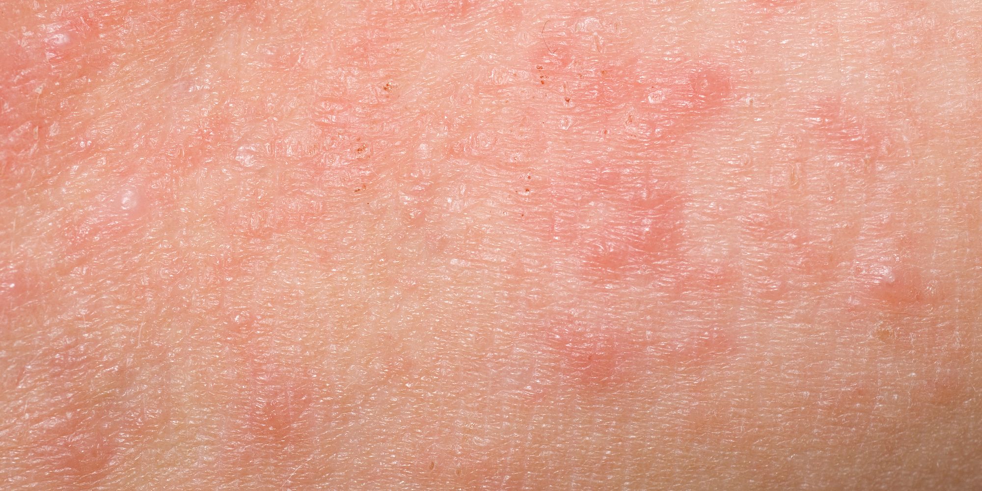 What Is Keratosis Pilaris, And Why Does It Look Like Body Acne? | The ...