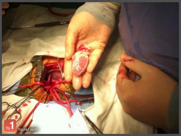 This image provides a rare look into a pediatric heart transplant procedure. The recipient in this case is a 13 month-old patient with congenital heart disease (CHD).