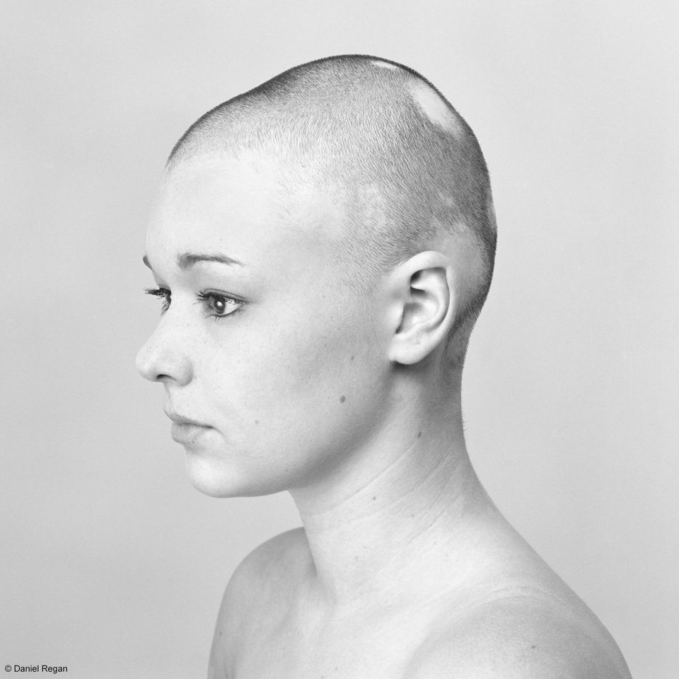Powerful Photos Of People With Alopecia Prove Bald Is Beautiful.