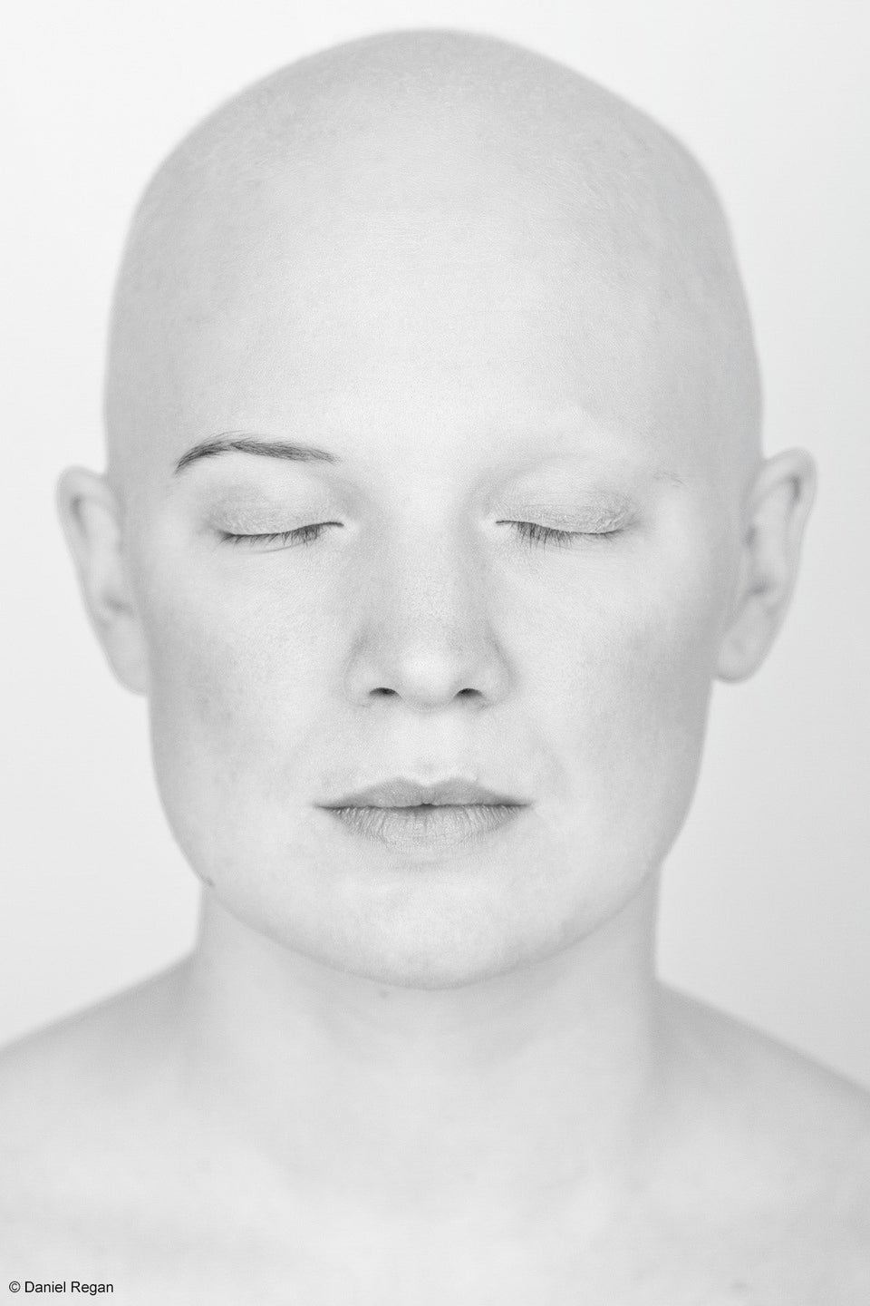 Powerful Photos Of People With Alopecia Prove Bald Is Beautiful ...