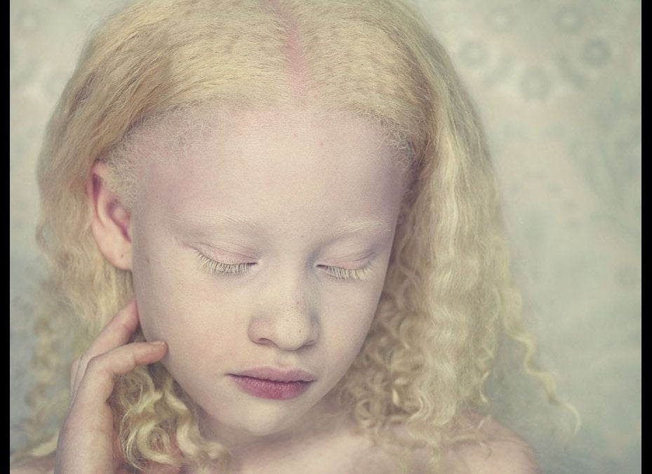 Portrait Series Highlights Beauty of Albinism, Birthmarks & Other Skin  Conditions