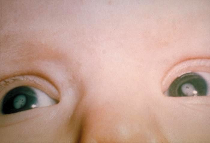 Cataracts in the eyes of a child with Congenital Rubella Syndrome.
