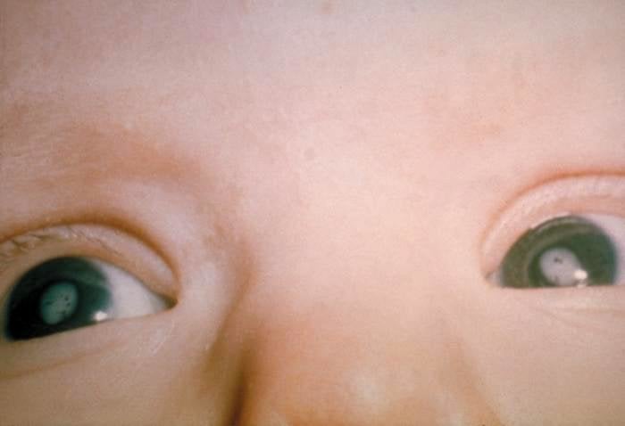 <p><span style="font-family: Arial, Helvetica, sans-serif; font-size: 14px; line-height: 20px; background-color: #eeeeee;">Cataracts in the eyes of a child with Congenital Rubella Syndrome.</span></p>