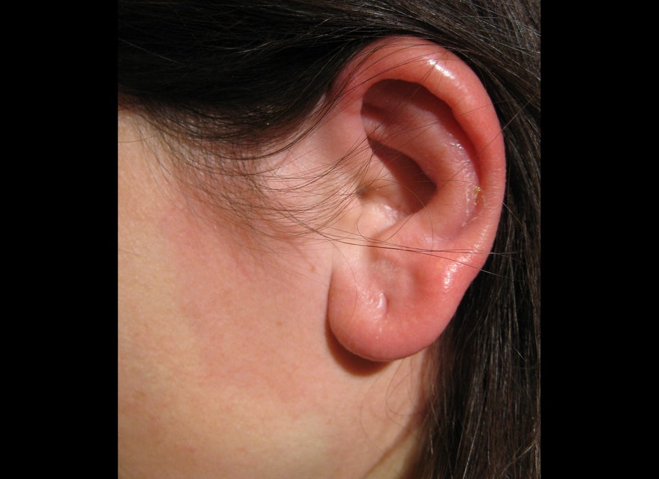 What's Swimmer's Ear Anyway?