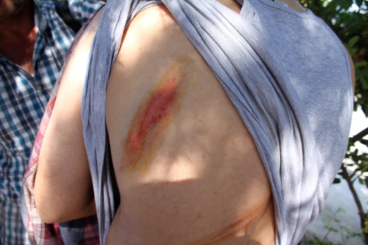 A Syrian lawyer and father of three shows whip marks on his back from what he said was an attack by masked gunmen in int