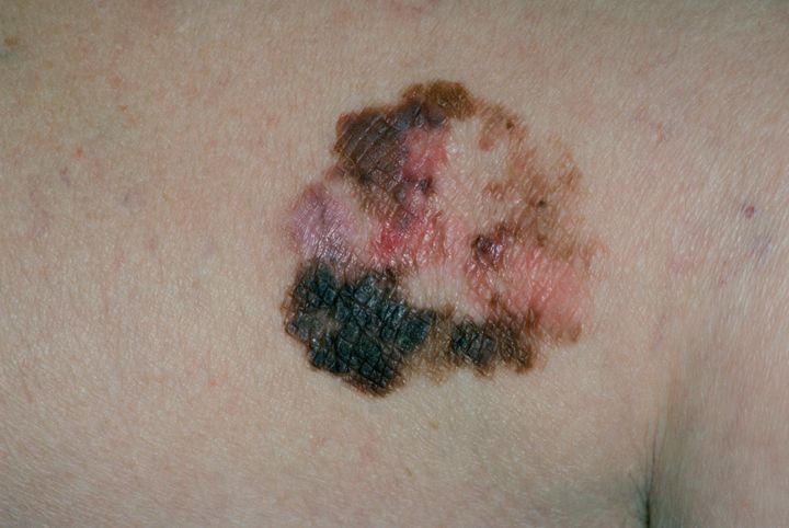 A malignant melanoma on a patient's skin. 