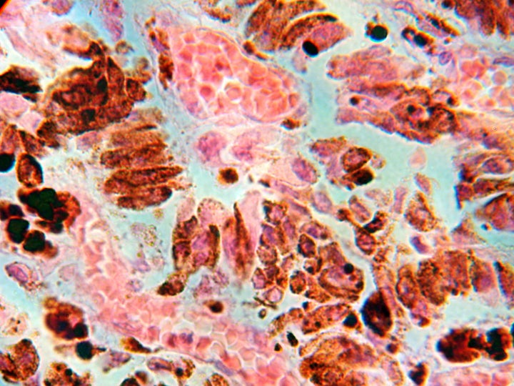 Malignant melanoma. 