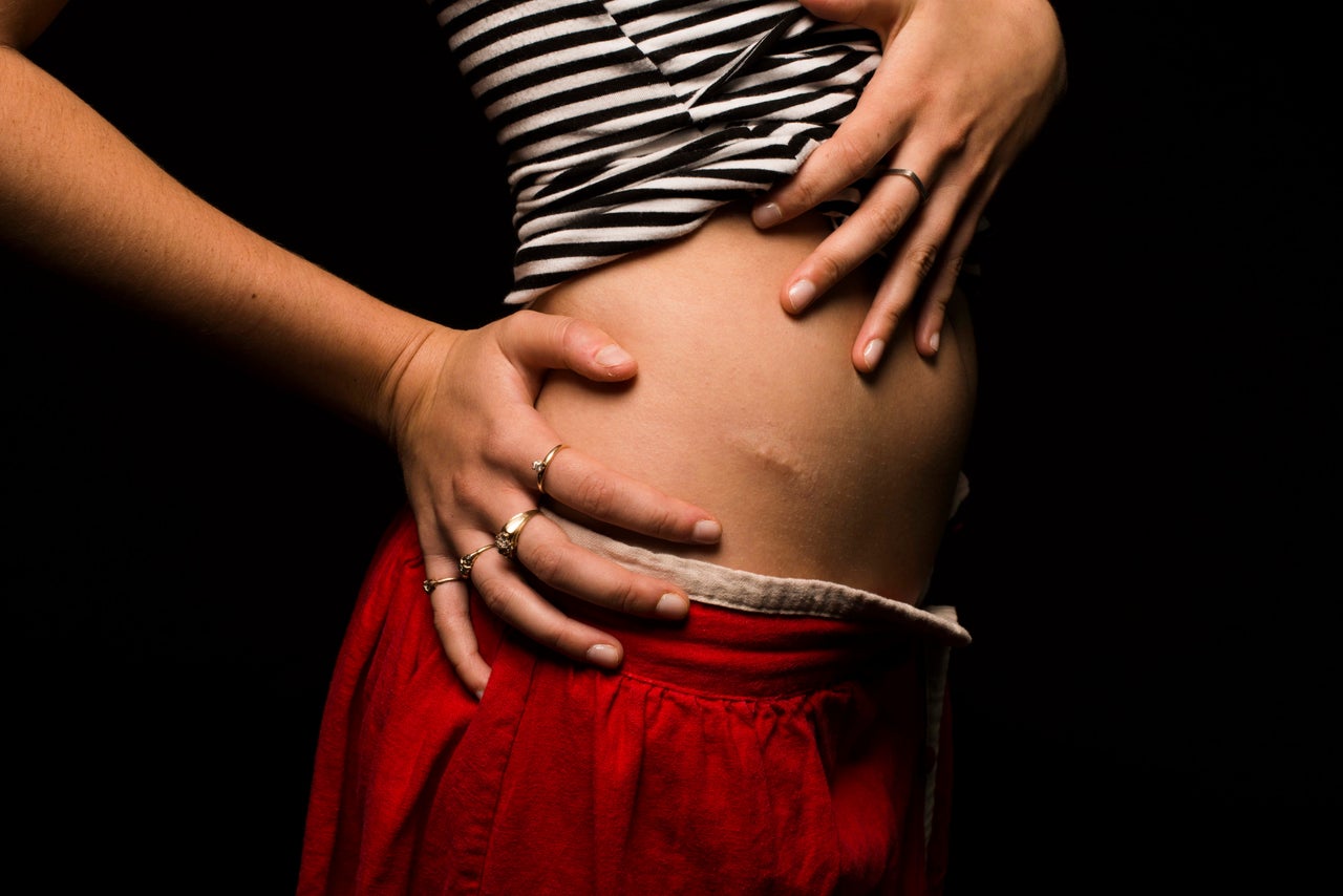 <p><em><strong>I was hit by a car while riding my bike in the North Carolina countryside.</strong></em><br><em><strong>I used to be really worried and self-conscious about it. I tried using some scar treatment cream to make it go away, and briefly obsessed about it, but eventually it really grew on me. </strong></em><br><em><strong>It's a battle scar that represents a time in my life when I was doing something I really loved, cycling. </strong></em><br><em><strong>-- Anonymous, 25</strong></em></p>