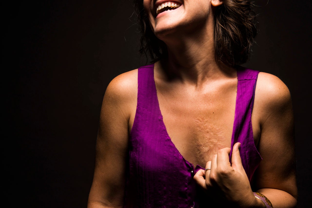 <p><em><strong>I was burnt with boiling water when I was 18 months old.</strong></em><br><em><strong>I've always been curious because it feels so distant to me, like something that happened to someone else, but I see the pain it caused everyone, and now as a parent to an 18 month old myself, I acutely feel how hard that must have been for them.</strong></em><br><em><strong>I hated my scar most of my life. </strong></em><br><em><strong>It was big when I was little and covered most of my chest. Bathing suits and leotards were a nightmare for me. Kids called me "moon crater chest" and always made fun of me. </strong></em><br><em><strong>I hid it until I was 22 years old. I could finally see my scar was small. I could see I wasn't hideous anymore. I could see it was just another beautiful part of me. Slowly I built a wardrobe that showed off my burn. I was finally proud.</strong></em><br><em><strong>I embrace my burn fully now and think she's beautiful and intriguing and mysterious. </strong></em><br><em><strong>-- Elise, 37</strong></em></p>