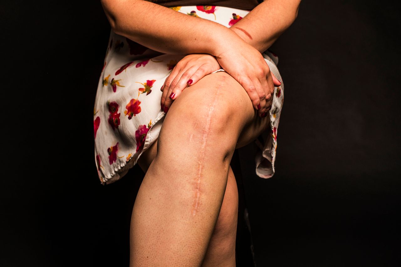 <p><em><strong>I think we are reared to believe that unblemished, unscarred things are most desired and beautiful, but having this scar helped me realize that my experience of getting two knee surgeries, and having to rehabilitate my leg twice, is highly valuable to me.</strong></em><br><em><strong>It's a reminder that we can heal no matter what happens to us.</strong></em><br><em><strong>It challenges our idea of beauty when we unpack the story and meaning of a scar.</strong></em><br><em><strong>--Gina, 28 </strong></em></p>