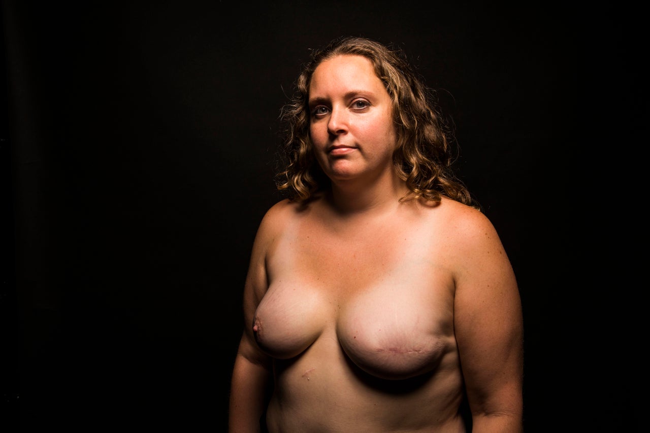 They are my badge of honor.Every time I look at them they give me strength. I feel lucky to be alive!In the beginning, I thought the scars were going to bother me but I have come to embrace them. -- Shanna, 35