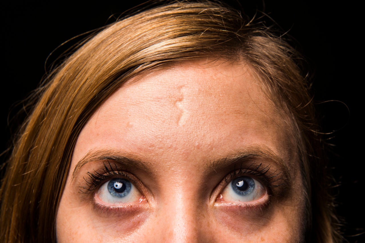 When I was thirteen, I moved from Australia to the U.S. and immediately got sick. A blistery rash broke out all over my body, which doctors later diagnosed as shingles. When it was gone, I was left with one deep scar in the center of my forehead.As a teen, I felt like my scar took away some of my "prettiness." It was hard not to focus on it when I looked in the mirror. One day in high school, a boy disgustedly told me I should "put some makeup on it" to cover it up. I think I cried at the time.It's faded over the years, and now I hardly notice it. It's become a part of my face. I like that it's shaped like a lightning bolt. My mum says it opens my third eye. -- Melissa, 31 