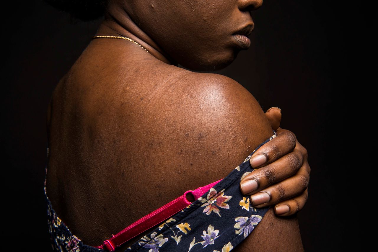 <p class="p1"><em><strong>I'm a dark-skinned woman and I've thankfully never really had a complex about my skin tone. I love my deep complexion, but my scars are discouraging because even for dark skin the "beauty standard" really emphasizes especially flawless skin. </strong></em><br><em><strong>Every dark woman you see celebrated in the media has this almost poreless complexion with no marks (think Lupita Nyong'o, Alek Wek, Naomi Campbell), and I definitely don't. </strong></em><br><em><strong>Accepting my scars has sort of been a way to accept myself.</strong></em><br><em><strong>Yes, sometimes I'll see a cute dress and see that it reveals some of my shoulders or back or chest, and there will be a pause. But I always decide to get the dress if I like it and I want it. Nowadays the pauses are getting a lot briefer. </strong></em><br><em><strong>-- Zeba, 26 </strong></em></p>