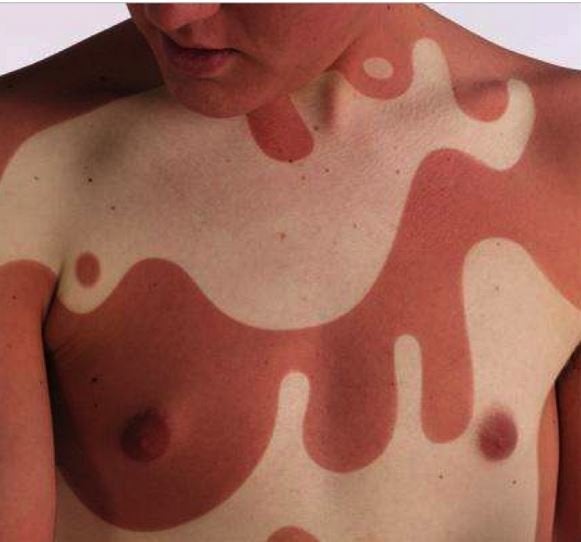 Sunburn art.