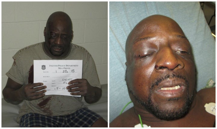 Floyd Dent's injuries, shown the night of his arrest and during his subsequent hospitalization.