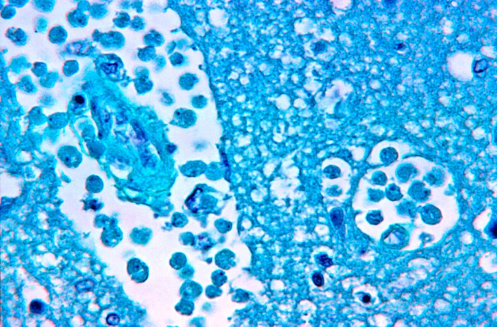 Magnified 500x, this photomicrograph of a brain tissue specimen depicts the cytoarchitectural changes associated with a free-living, Naegleria fowleri, amebic infection. 