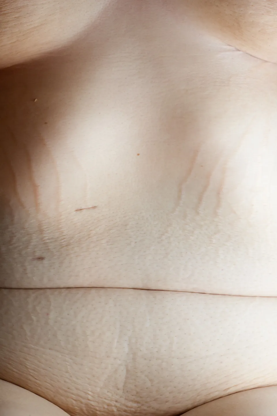 One Woman Shows The Unretouched Reality Of Major Weight Loss (NSFW) |  HuffPost Life