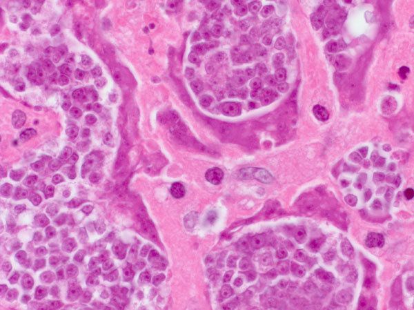 Parasitic tumor cells