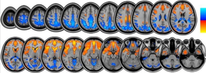 Brain scans from the NASA study show changes in brain volume that occur during long-duration head-tilted bed rest, which are similar to the changes seen after spaceflight.