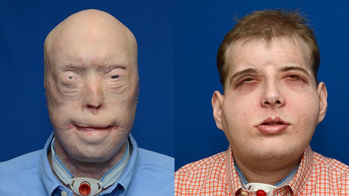 Hardison's face before and after the face transplant surgery.