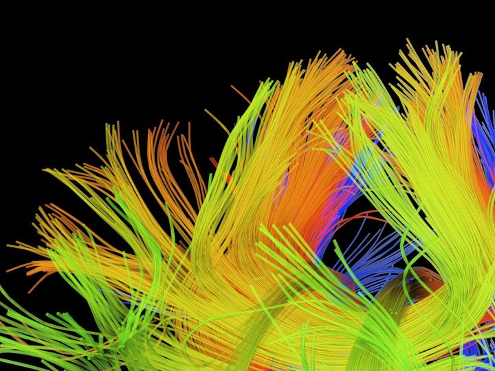 Colored 3D diffusion spectral imaging (DSI) scan of the bundles of white matter nerve fibers in the brain.