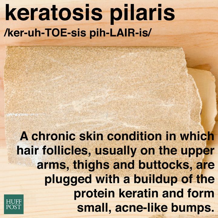 What Is Keratosis Pilaris And Why Does It Look Like Body Acne Huffpost Life